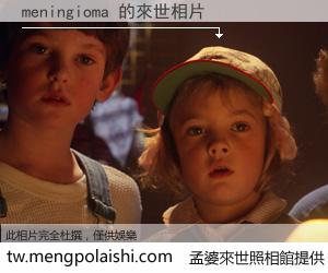 meningioma 來世的未來相片